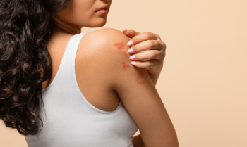 Top 15 Signs of Atopic Dermatitis Rash